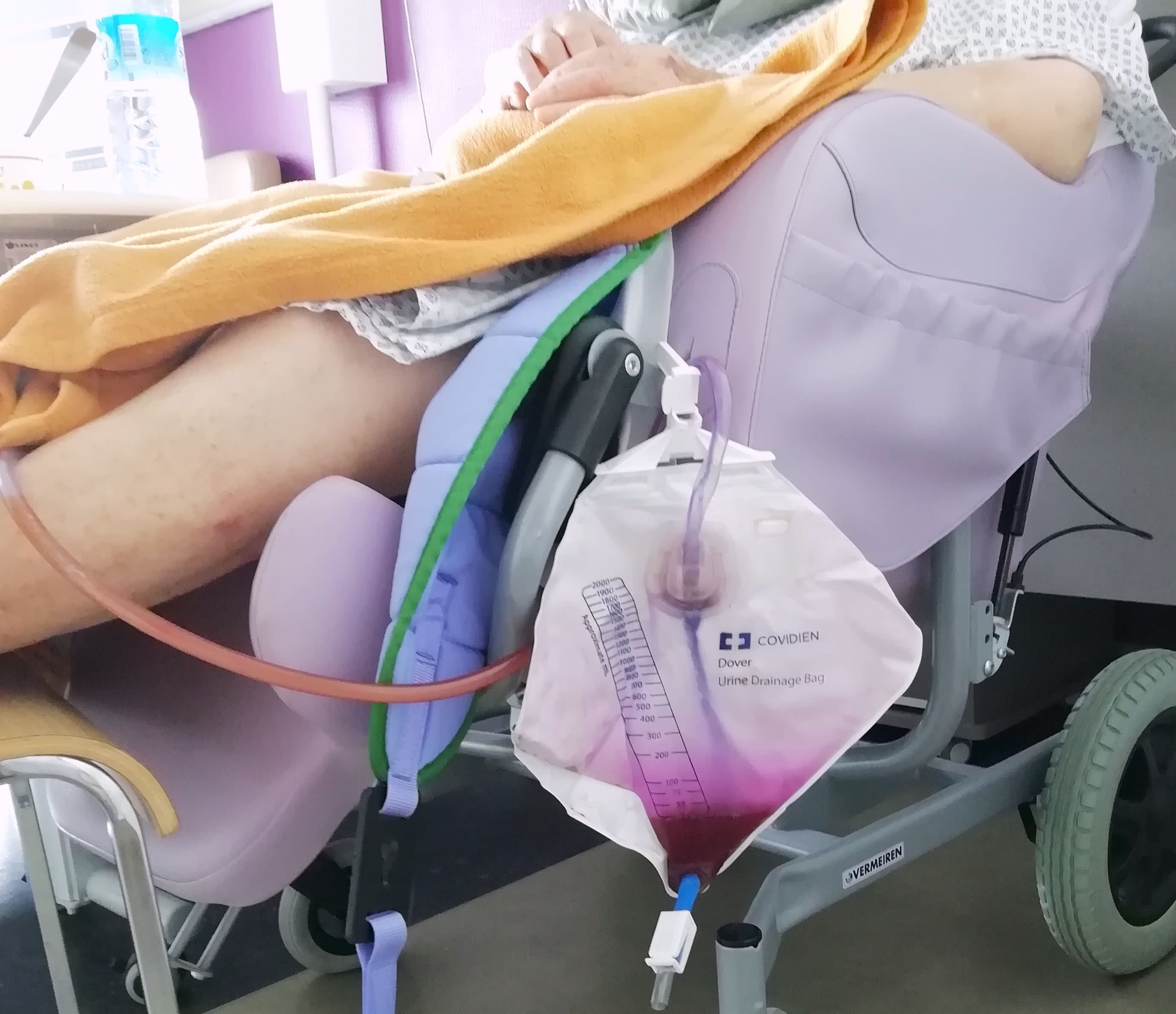 Le Syndrome Du Sac Collecteur D Urine Violet Pour Les Infirmieres Maeker Fr